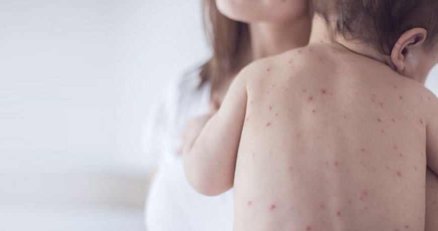 Медики назвали единственный способ защититься от кори