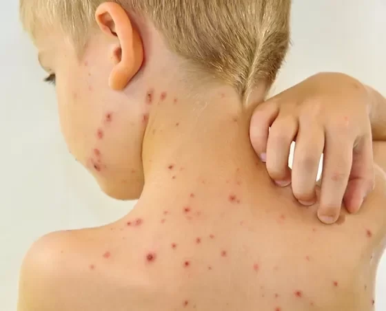 Малышева предупредила, что корь приводит к разрушению головного мозга