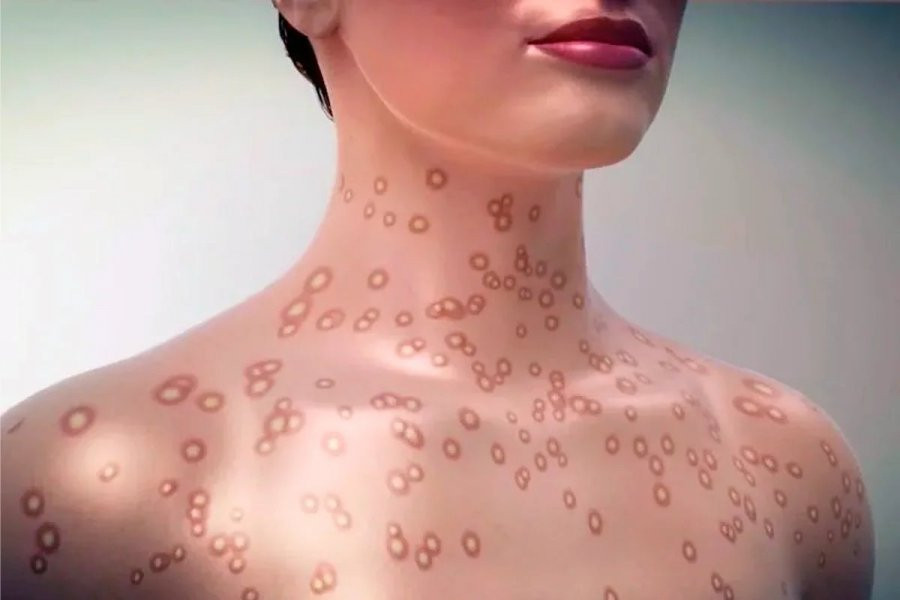 В Новосибирской области на 33% увеличилось число заболевших сифилисом человек