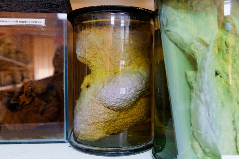 “Видишь и сразу отвращение”: показано максимально жуткое состояние печени (фото)