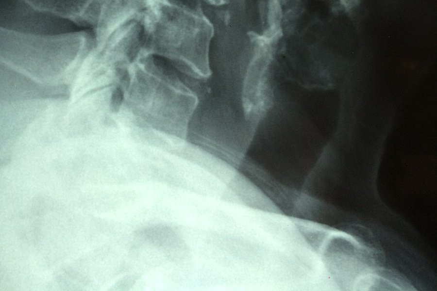 Испанские ученые назвали главную ошибку, допускаемую онкологами при лечении рака