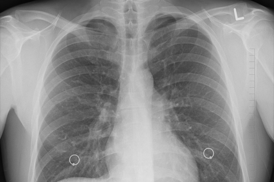Разработанная калужанами технология анализа КТ по семи видам патологий запущена в Москве