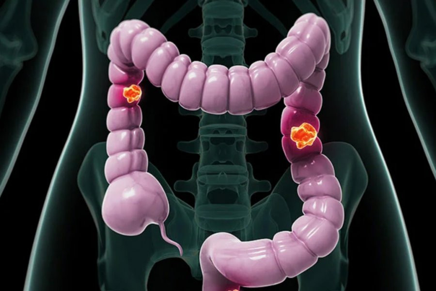 Онколог назвал первые симптомы рака кишечника: Невозможно не заметить