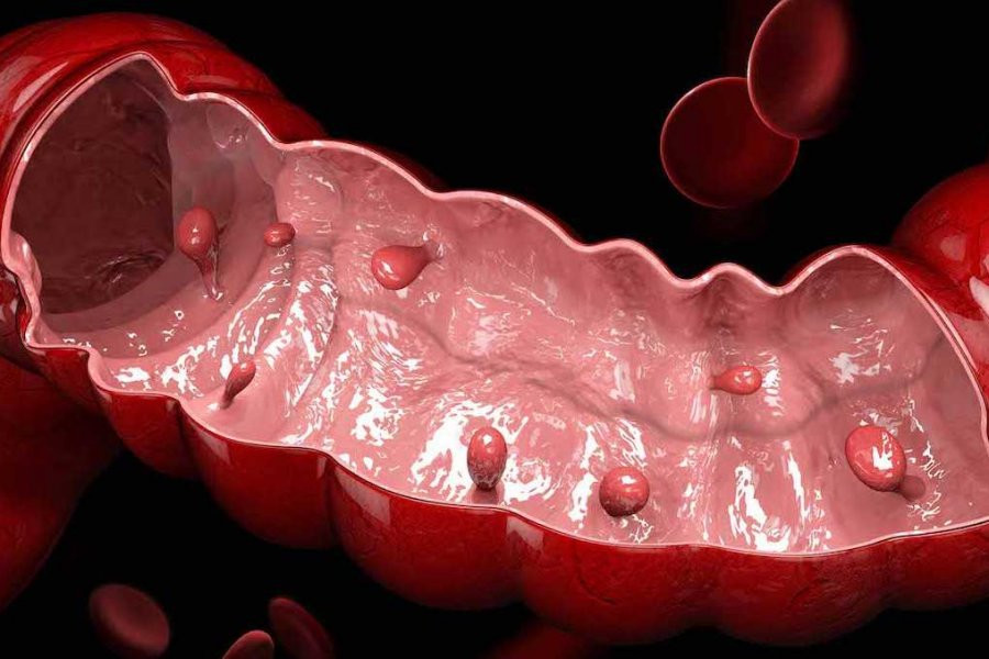 «Растут, как грибы после дождя»: Онколог рассказал о первом признаке рака