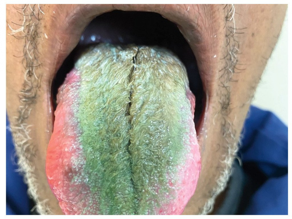 Язык американца позеленел и «покрылся волосами» после антибиотиков