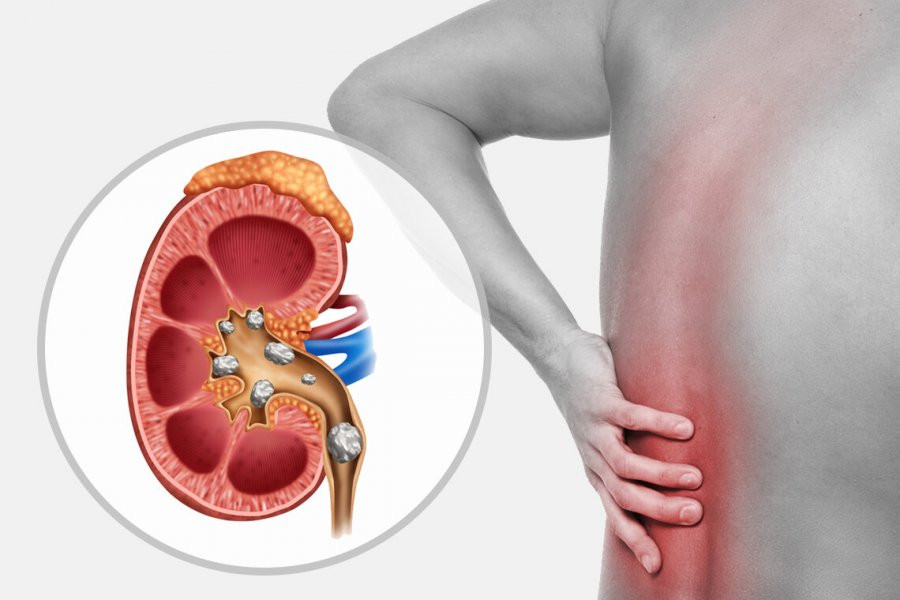 Назван способ борьбы с камнями в почках человека во время жары