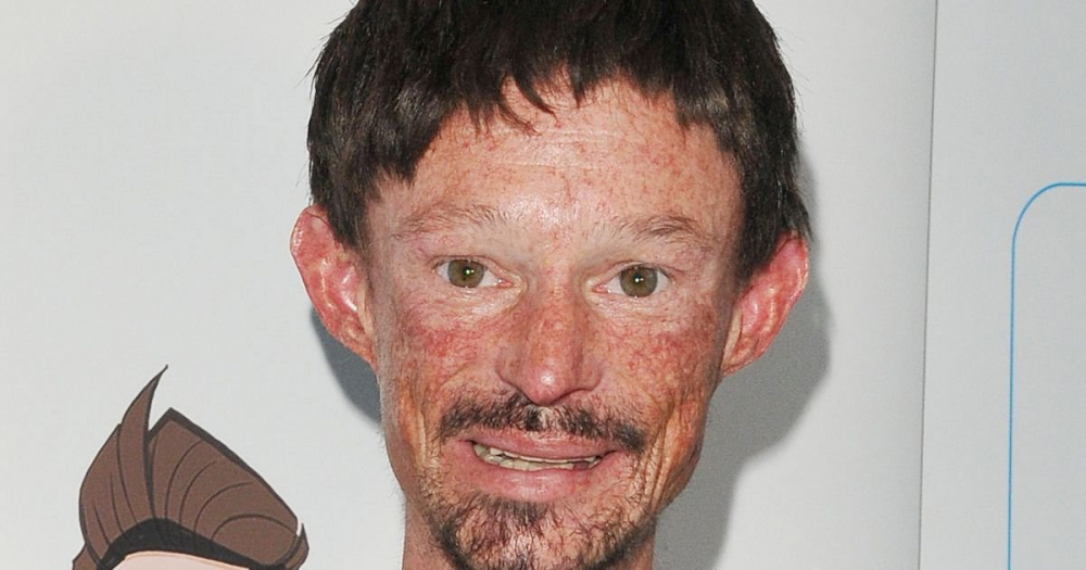 Умер 36-летний актёр из «Игры престолов», страдавший от неизлечимой болезни кожи