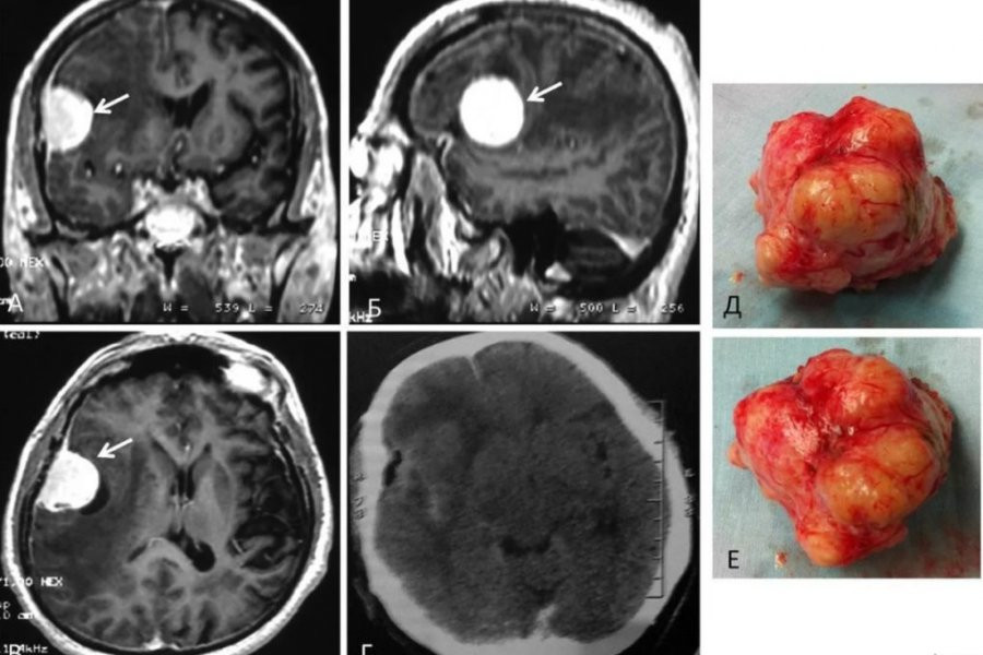 Британец стал подозревать жену в измене из-за раковой опухоли
