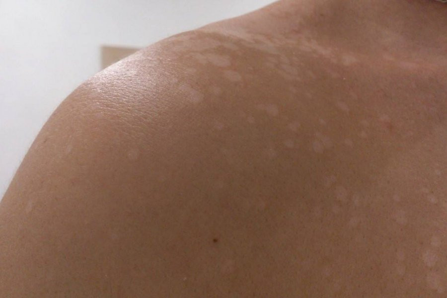 «Синяки, пятна, утомляемость»: Травматолог рассказал, как обнаружить дефицит витаминов без анализов