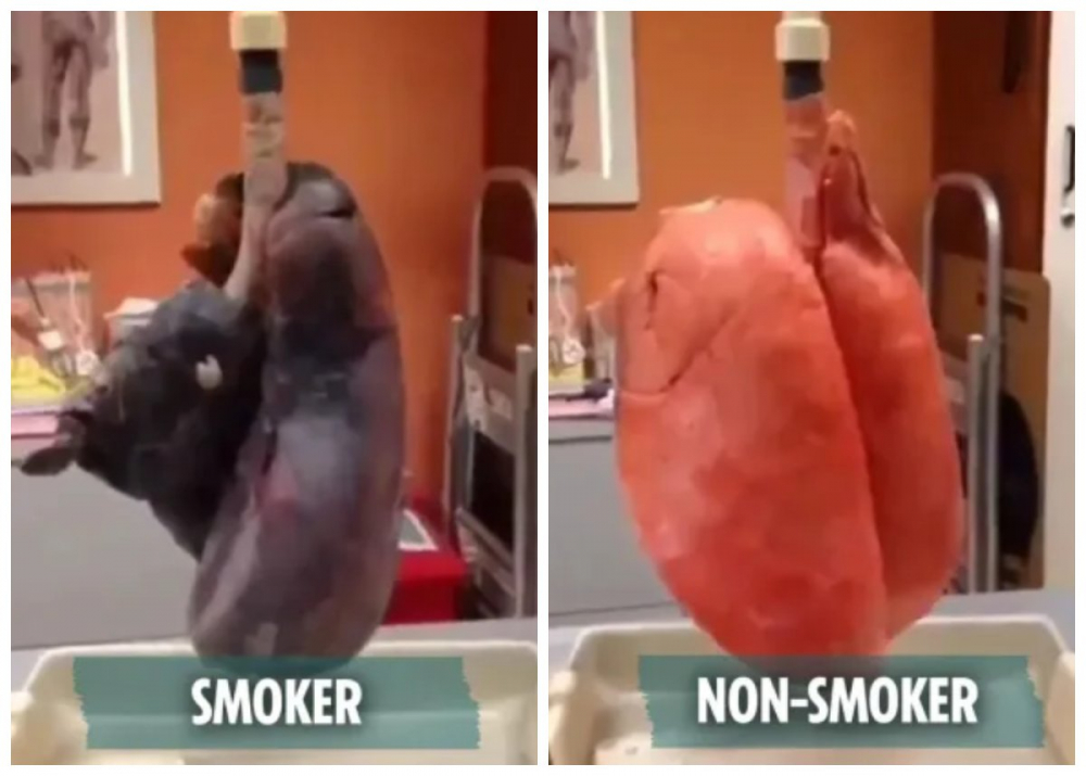Дыхание захватывает: Ужасающие фото показывают разницу между легкими курильщиков и некурящих