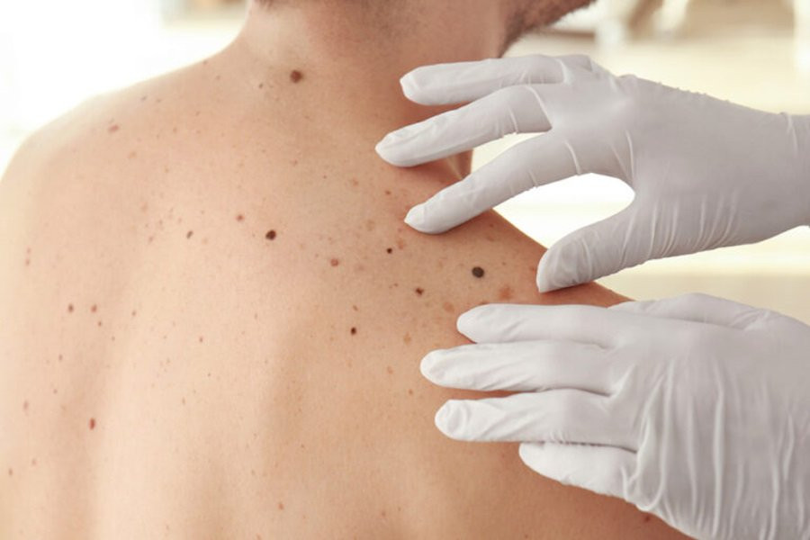 Немеланомный рак кожи смертельнее меланомы