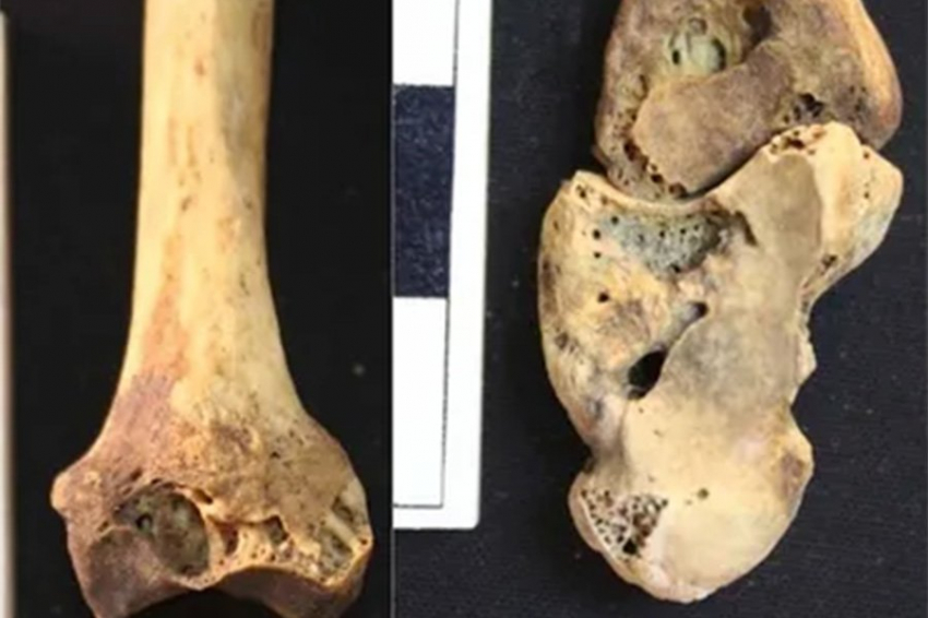 Ученые выявили самый ранний из известных случаев ревматоидного артрита в мире