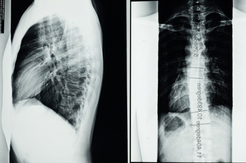 Neuron: ускорение кровотока при операции на спинном мозге помогает избавиться от боли