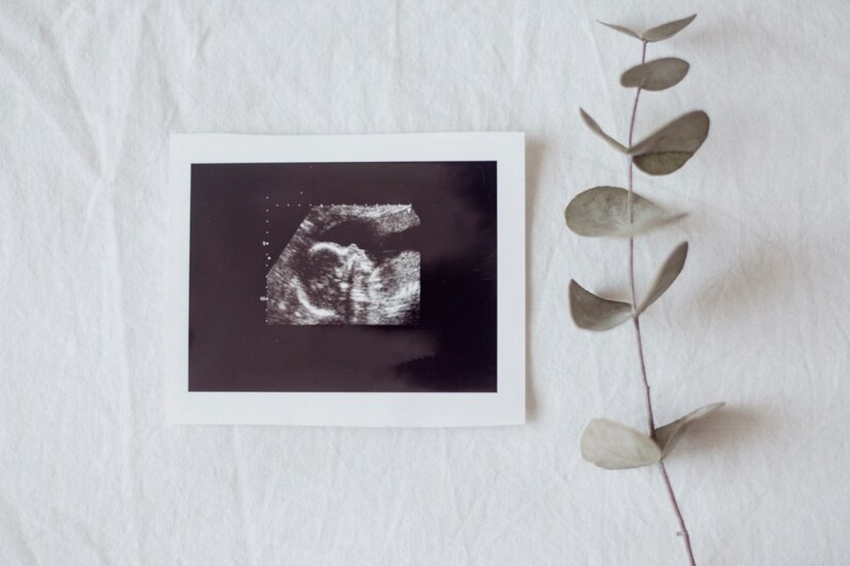 Бразильянка 50 лет вынашивала «каменного ребенка»: была беременной в 81 год — что такое литопедион