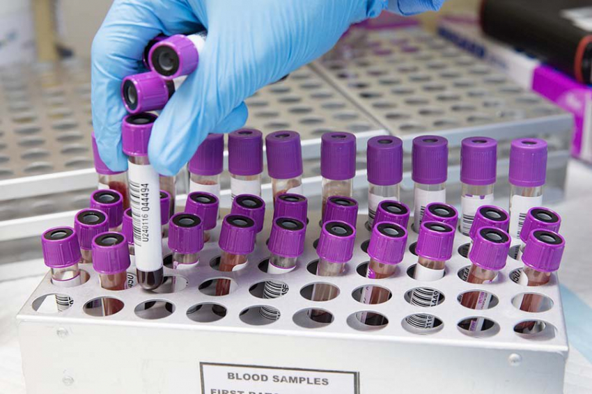 Выявлены общие между ревматоидным артритом и раком крови генетические мутации